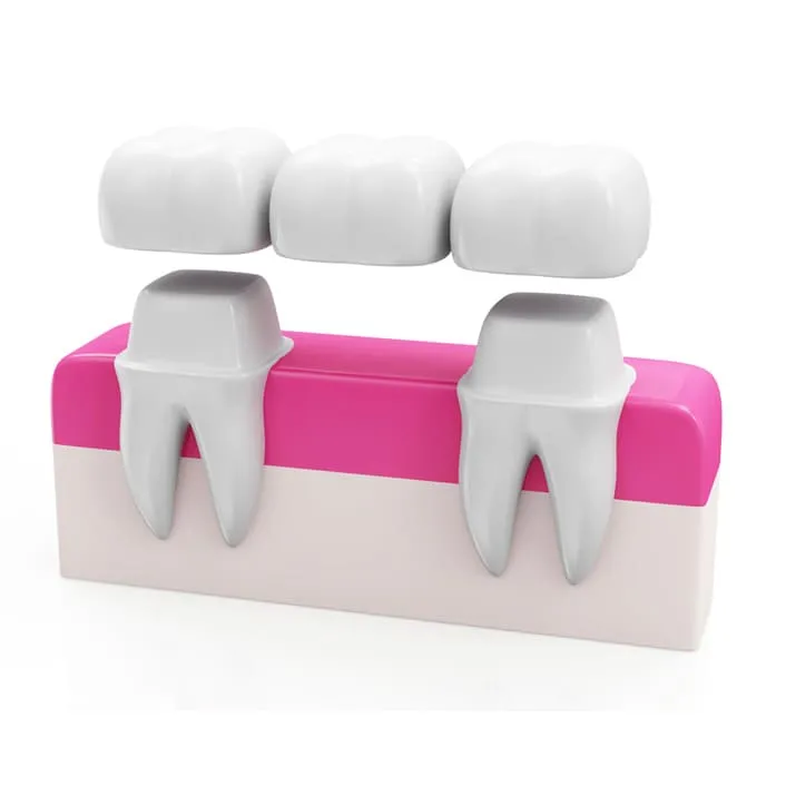 Dental bridge illustration showing an artificial tooth supported by the two adjacent natural teeth