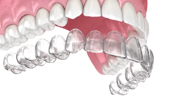 Illustration of a clear dental aligner fitted over a row of teeth.
